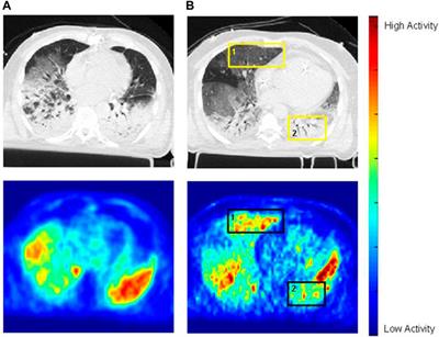 Molecular imaging of inflammation with PET in acute and ventilator-induced lung injury